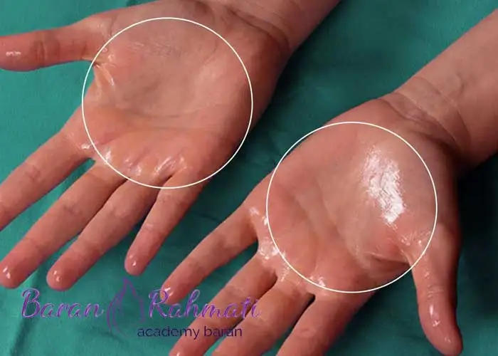 Read more about the article آموزش بوتاکس کف دست برای تعریق