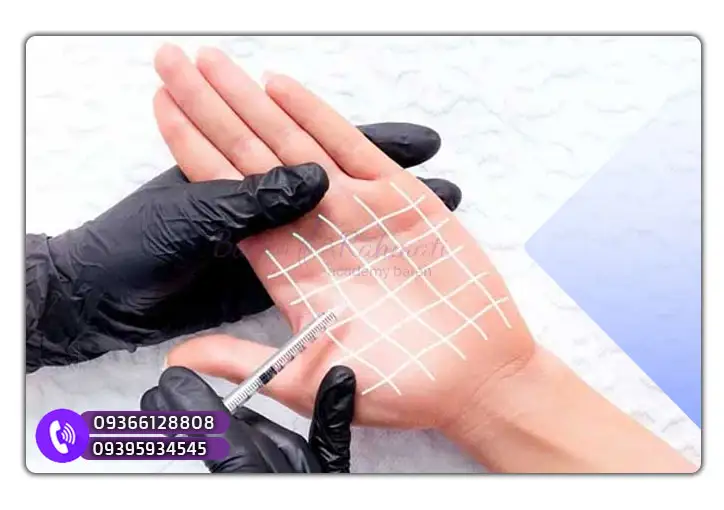 نقاط تزریق بوتاکس در کف دست