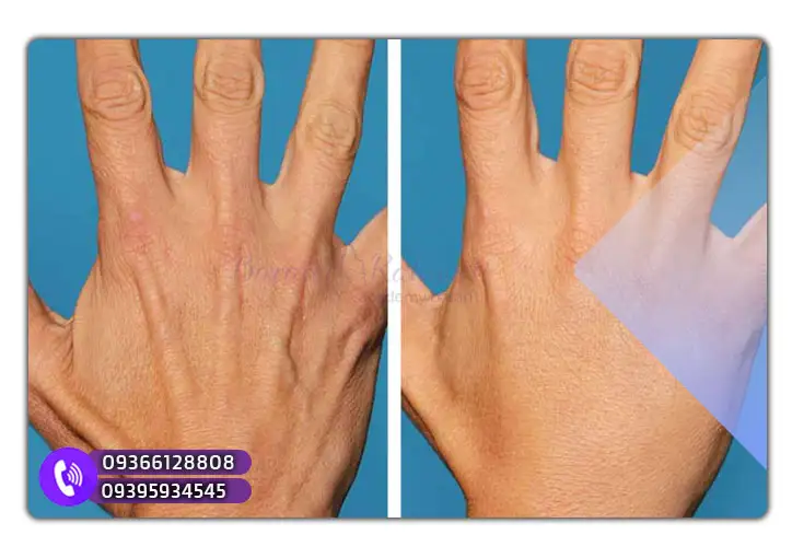 کاندید مناسب برای جوانسازی دست‌ ها با مزوژل