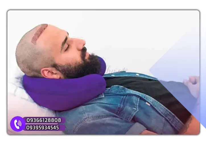 مراقبت از گرافت‌ های کاشته شده مو