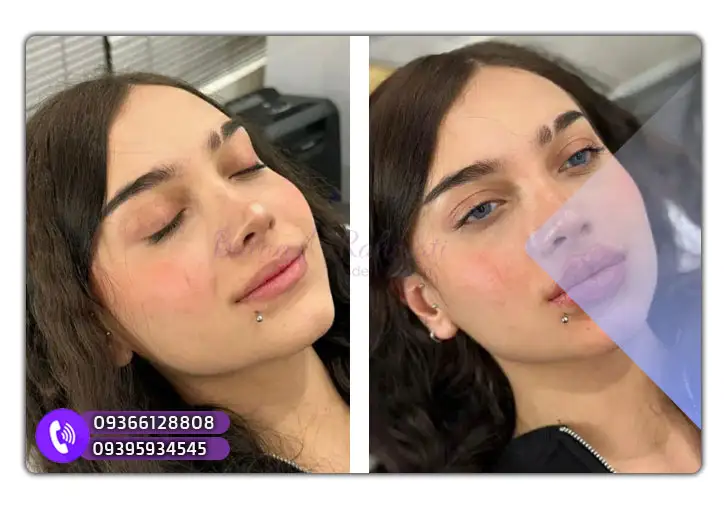 آموزش تزریق ژل لب در آکادمی باران رحمتی