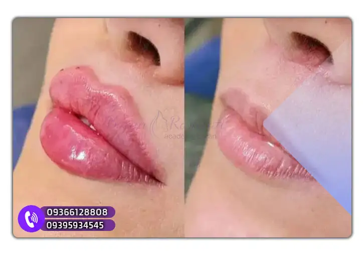 آموزش تخصصی تزریق ژل لب