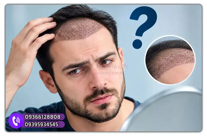 سوالات حمام بعد کاشت مو