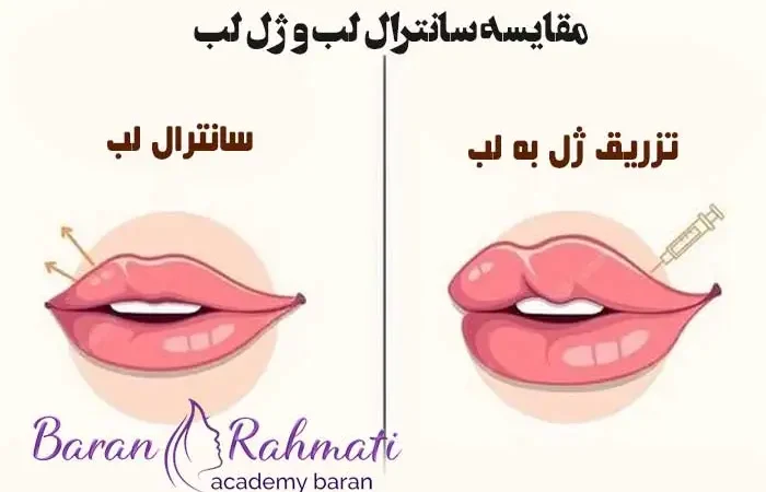 سانترال لب یا تزریق ژل