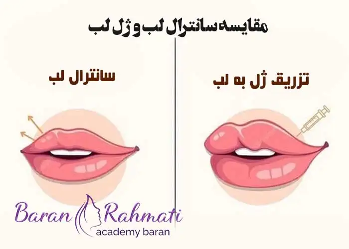 Read more about the article بهترین راه زیباتر شدن لب‌ ها: سانترال لب یا تزریق ژل؟
