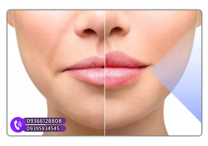 انجام ژل لب و سانترال با هم