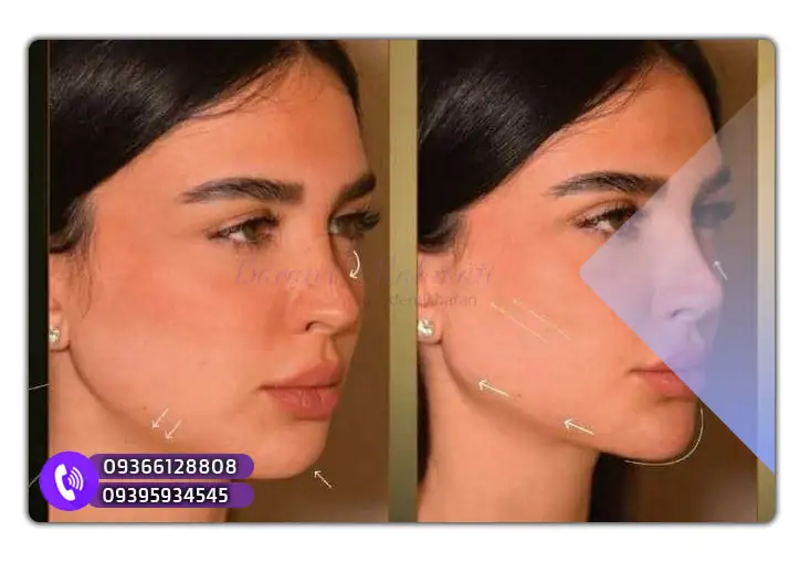 بهترین آکادمی برای آموزش ژل و بوتاکس کردستان