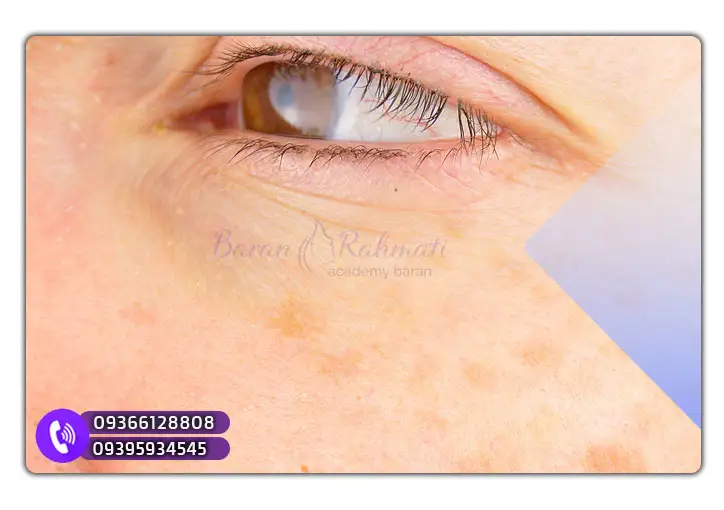 روش‌های درمان لکه‌های پوستی کبدی