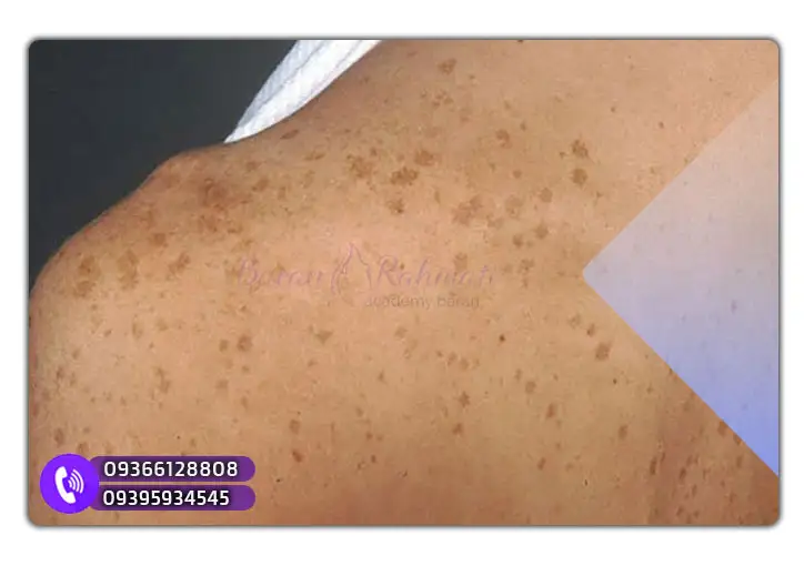 افراد مستعد برای ایجاد لکه‌های کبدی