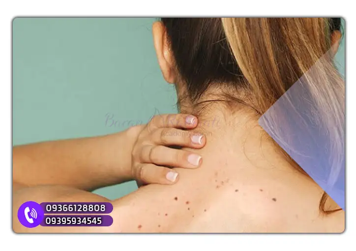 جلوگیری از لکه‌های پوستی کبدی