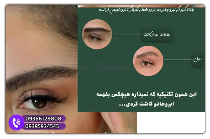 آموزش کاشت مو سمنان در آکادمی باران رحمتی