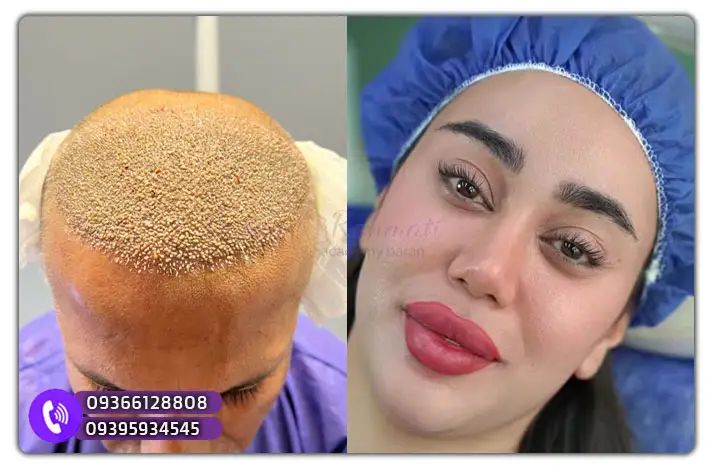 هزینه دوره آموزش تخصصی کاشت مو و ابرو در کردستان