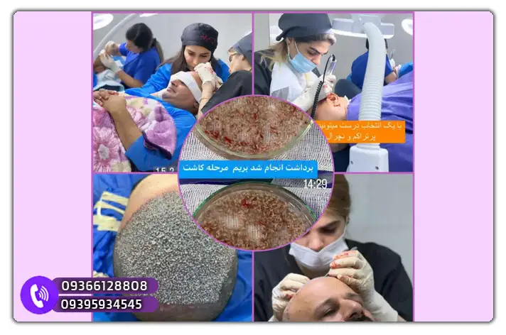 بهترین مرکز برای یادگیری کاشت مو در کردستان