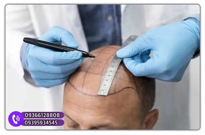 سرفصل‌های دوره آموزش کاشت مو در مازندران