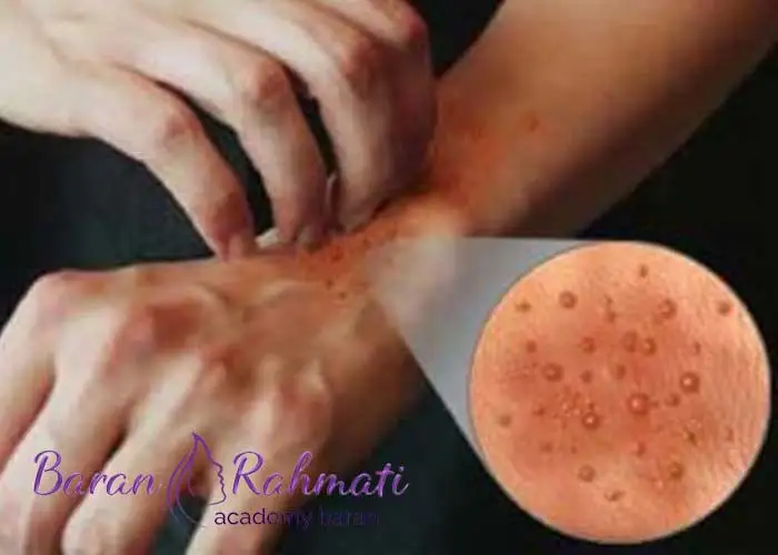 Read more about the article چرا دانه های ریز روی پوست دست ایجاد می شوند؟