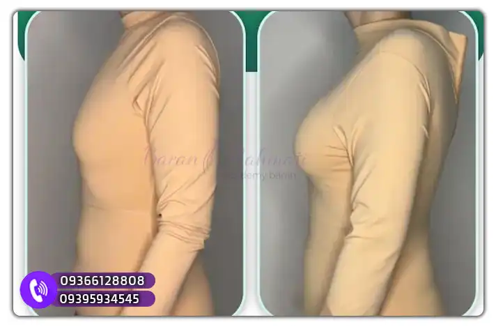 آموزش فیلر سینه در اصفهان در آکادمی باران رحمتی