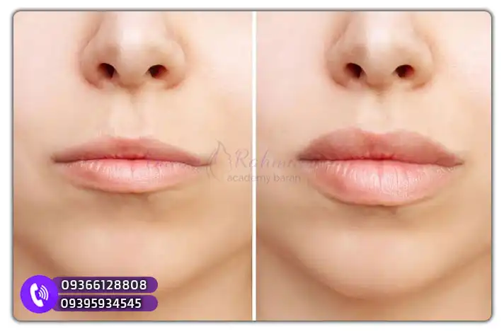 آموزش عملی تزریق ژل لب مرکزی