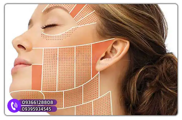 ارائه مدرک دوره هایفوتراپی در آکادمی باران رحمتی